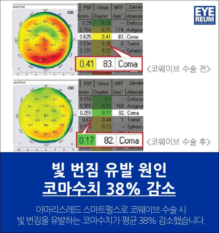 강남라섹, 유명한 이유가 있다!