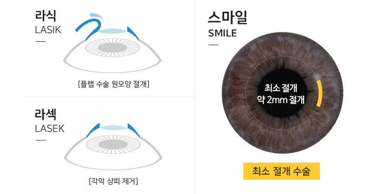 라식라섹차이 궁금하신 분 손 번쩍 들어주세요!