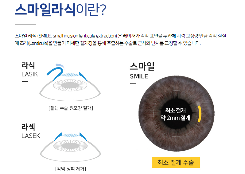 스마일라식가격, 유명함에는 이유가 있다★
