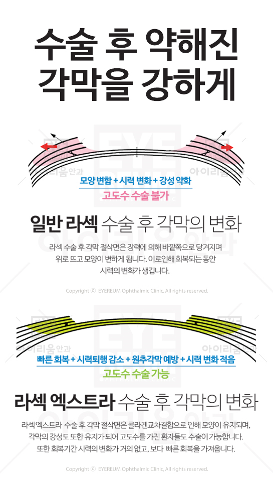 각막강화술, 라식라섹 후 시행하는 이유?