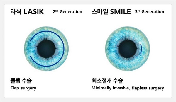 스마일라식회복? 이걸 하루 만에??