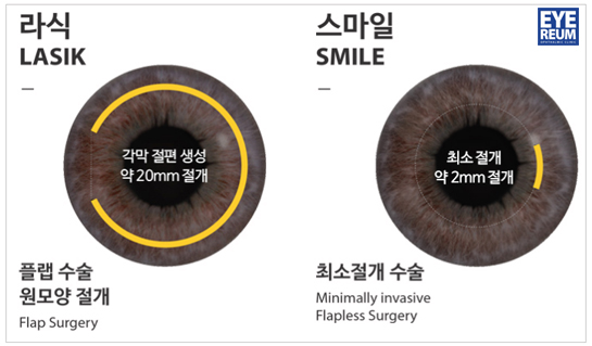 스마일라식 묻고 로우에너지로 가!!