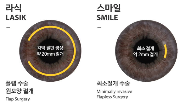 라식수술추천, ㅇㅇ님은 ___이 적합해요.