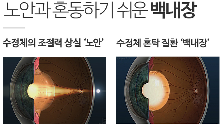 레이저장비를 이용한 백내장 수술 , 환자 만족도 높은 이유