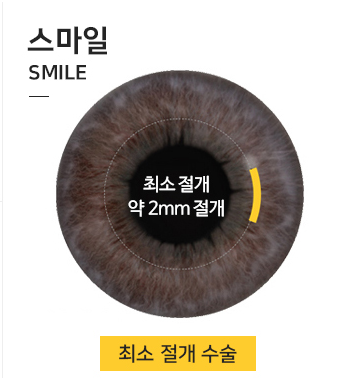 스마일라식렌즈삽입술, 결국 선택은 ooo로!