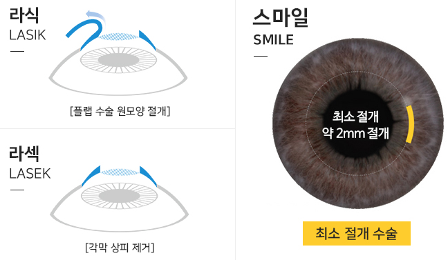 스마일라식회복? 누구보다 빠르게 난 남들과는 다르게