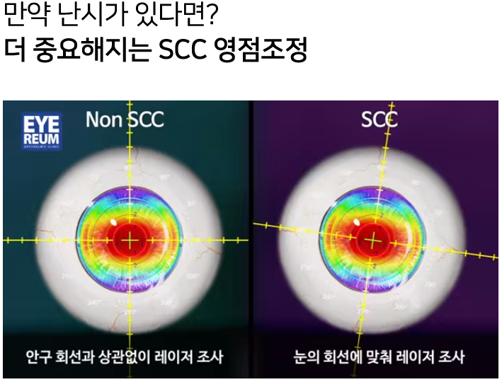 고도난시 라섹으로 선명한 시력 찾기!