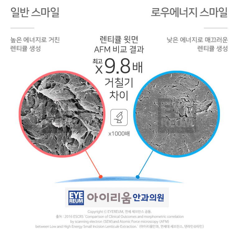 스마일라식 수술시간 주의사항 알아보기