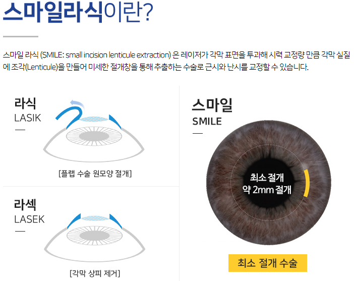 라식회복기간, 방법의 차이!