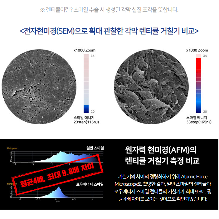 로우에너지 스마일라식=각막손상↓ + 시력의 질↑