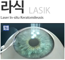 스마일라섹가격과 라식후기 확인해요