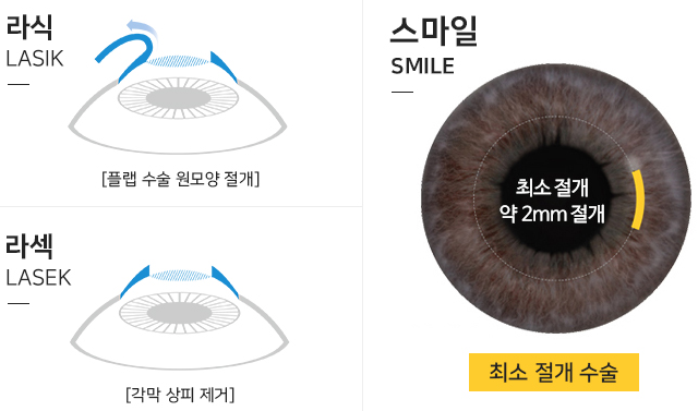 스마일라식! 비용, 로우에너지 장점