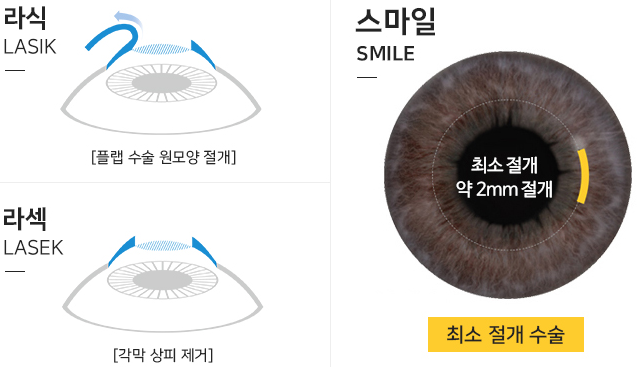 스마일라식안과 선택에 따라 다른 시력의 질?!