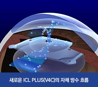 5년 연속 이보플러스ICL 베스트 센터로 선정, 아이리움안과를 선택하는 이유 사진 3