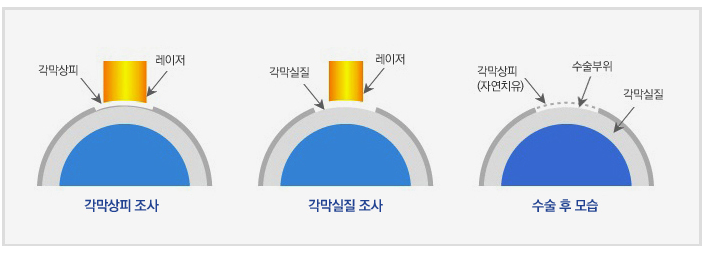 라섹후기에 개강이 밀렸다?!
