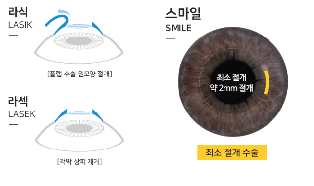 군인라섹, 라식 복무 중에도 안전하게!