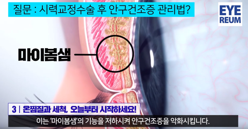 눈이 건조하다면? 올바른 눈세정법
