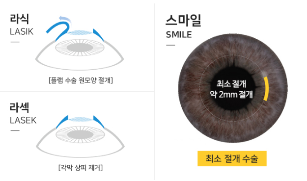 스마일라식가격, 후기까지 확인해봐요~
