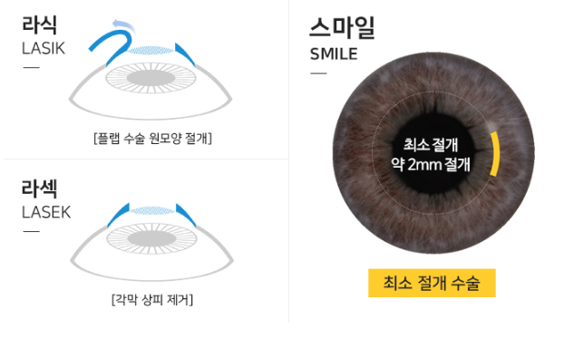 라식수술전 알아야 할 스마일라식주의사항