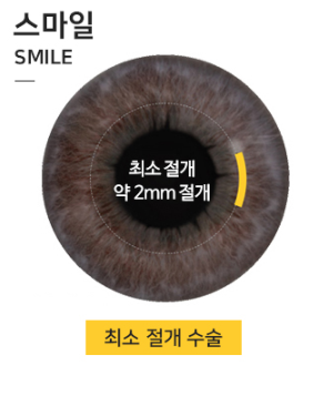 군인스마일라식 입대 전, 휴가 중에도 안전하게