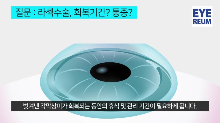라섹수술회복기간 살피기 ※강남역편