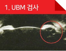 ICL렌즈삽입술 밖에 안된다는데,, 안과 선택이 중요! 사진 2