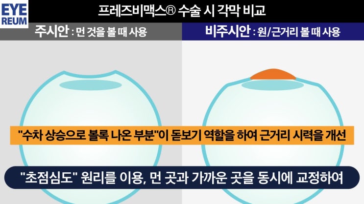 노안수술? 라식? 40대이후 시력교정은?
