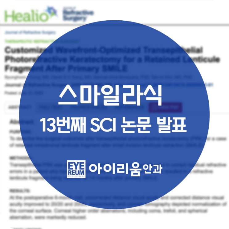 스마일수술 재수술 관련 아이리움 논문 발표