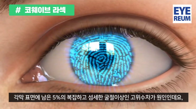 고도근시라섹 해결될까?
