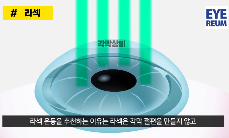라섹운동 언제부터 가능해요? 라섹 FAQ
