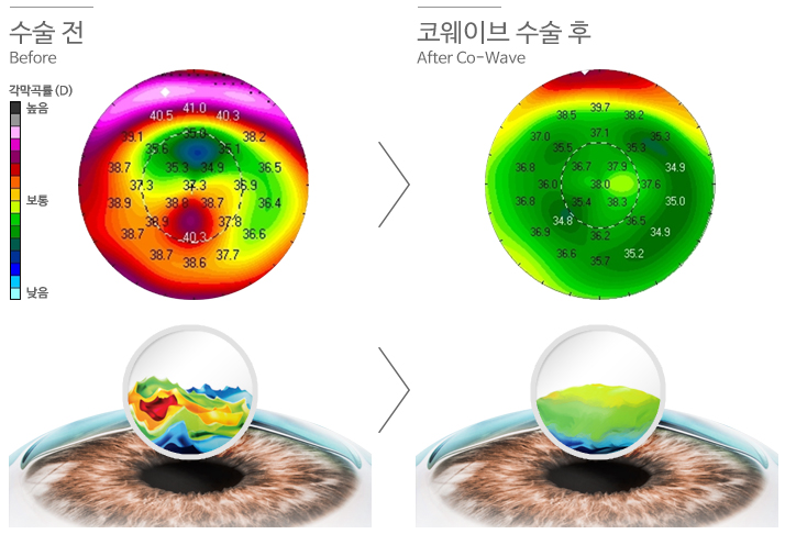 강남라섹으로 필(必)마스크 시대의 불편함 해소하기