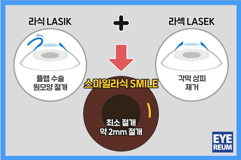 라섹비용, 회복기간, 수술 후 주의사항 궁금합니다