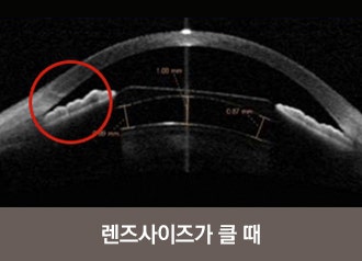 아쿠아렌즈삽입술 후 결과는? 수술 전 검사과정에서 찾을 수 있다! 사진 3