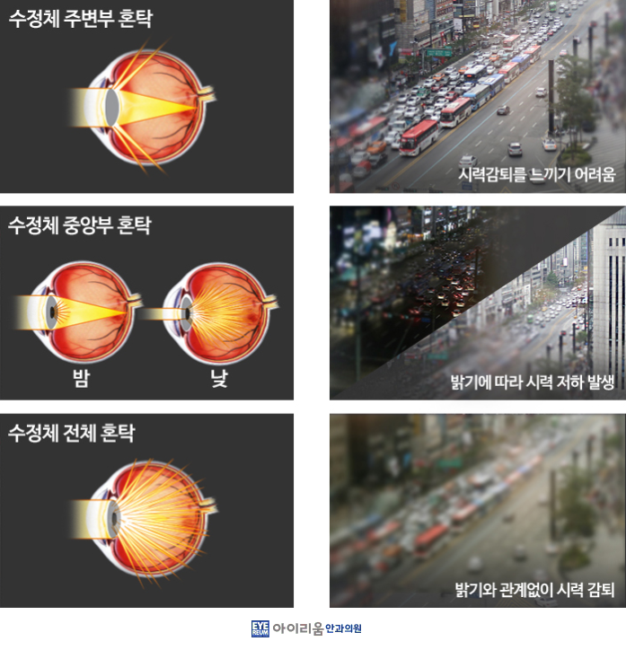 시야가 답답하세요? 백내장증상일 수 있습니다.