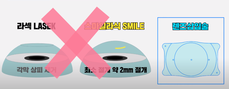 렌즈삽입술, 집도의가 중요한 이유