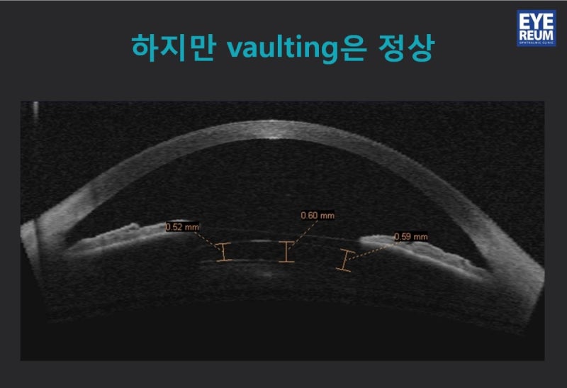 렌즈삽입술, 집도의가 중요한 이유 사진 5