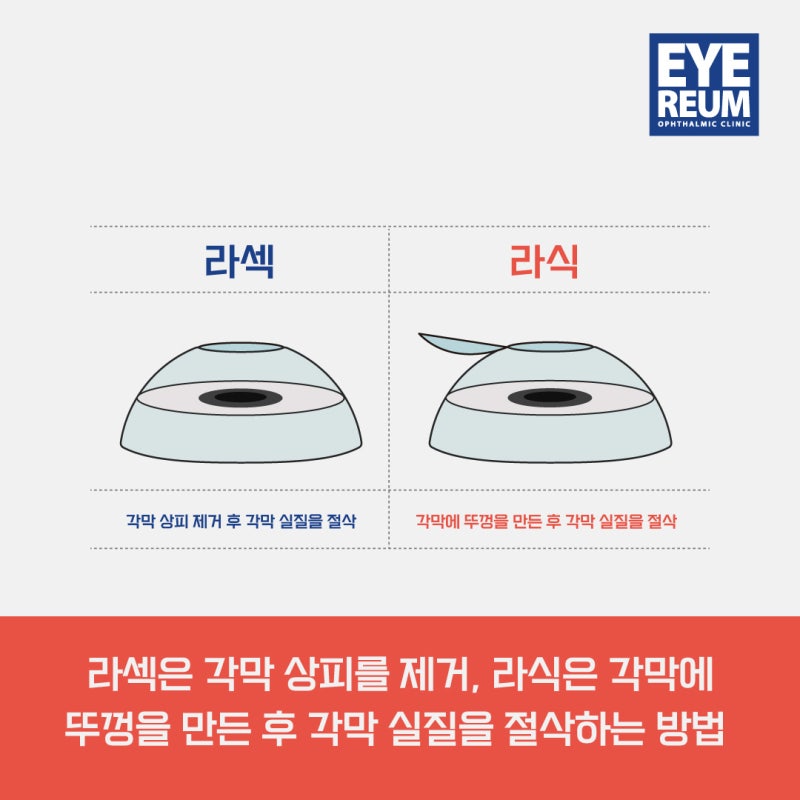 라섹가격, 라섹수술 고민중인가요?