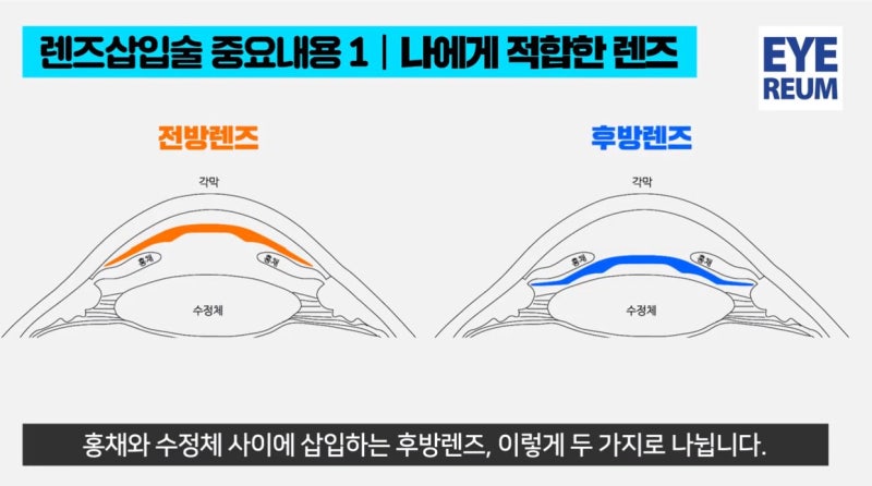 ICL렌즈삽입술, 고도근시만 적합한가요?
