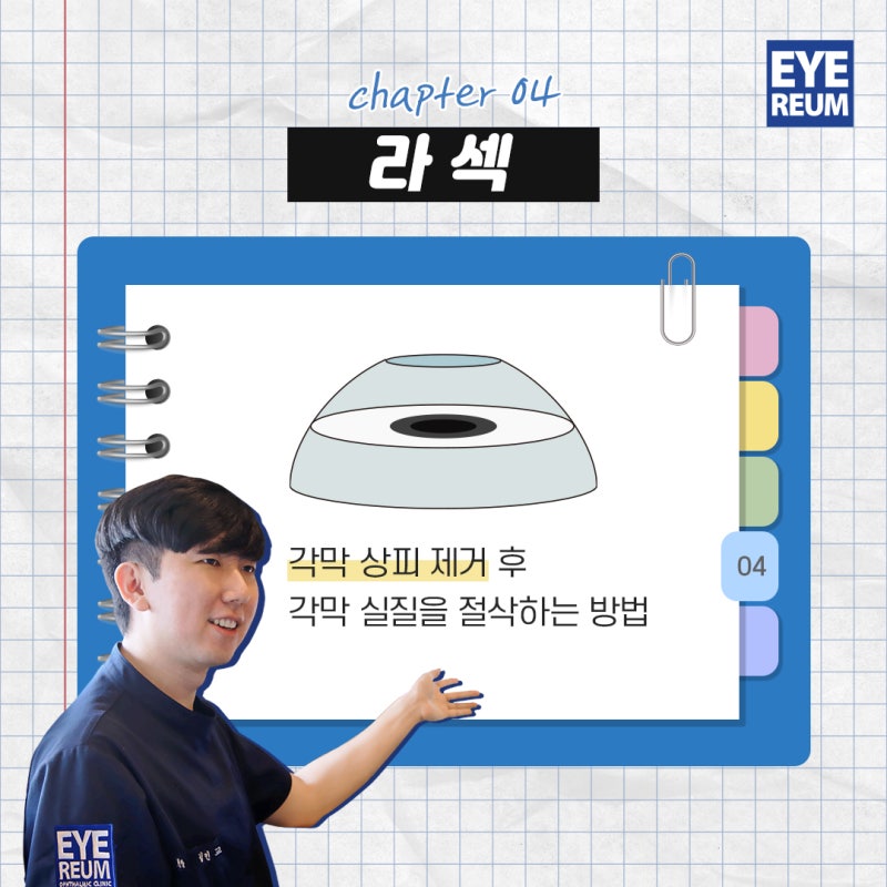 고도근시 라섹, 안전한 수술을 위한 TIP!