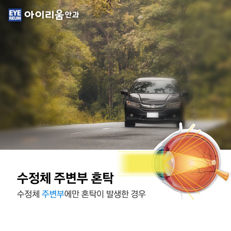 백내장 종류 별 다른증상 [나는 무슨 백내장?] 사진 4