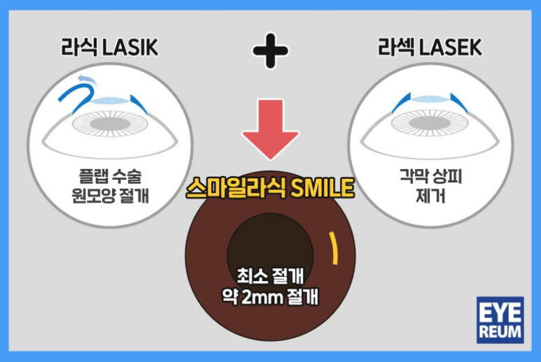 스마일라식 난시교정 벡터플래닝? 백타분석? 어려워요..