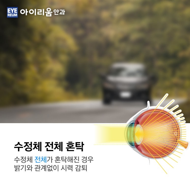 당뇨 환자의 백내장수술과 치료 사진 2