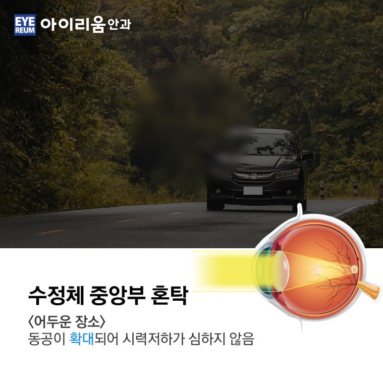 당뇨 환자의 백내장수술과 치료 사진 4