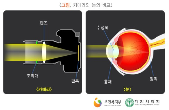 백내장수술 후 주의사항 알아보기