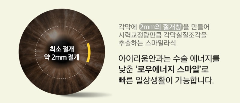 서울 스마일라식수술당일 11월 계획? [강남 아이리움안과 편]