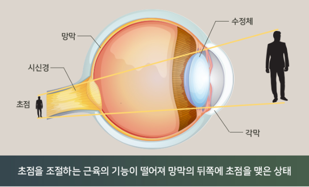 노안 치료 궁금증) 노안교정수술 필요할까?