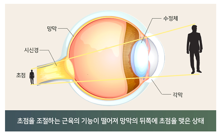 노안 치료가 필요할때 - 노안증상 바로 알기
