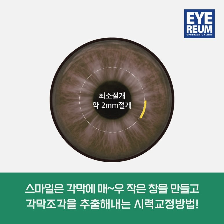 스마일라식 눈화장, 언제부터? 수술 다음날 👌!