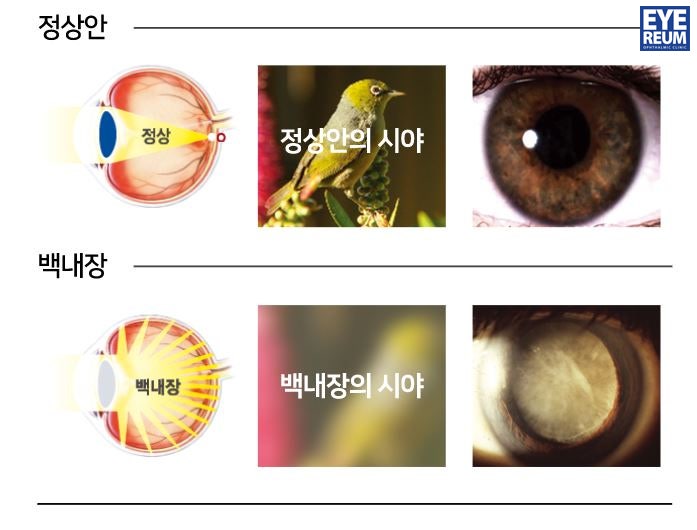 백내장수술병원 지금 가야할까?