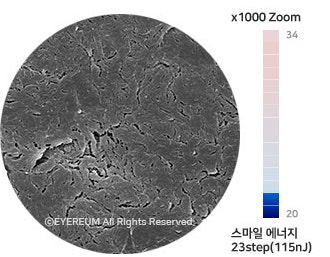 스마일라식, 라섹, 렌즈삽입술 - 1:1 맞춤수술은 어떻게 다를까? 사진 3